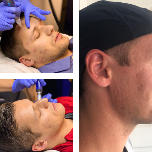 microneedling-before-after