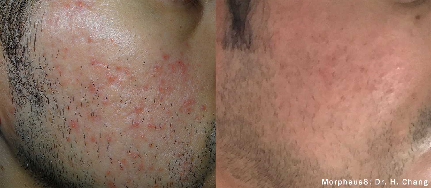Morpheus8 Before and After Acne Scarring