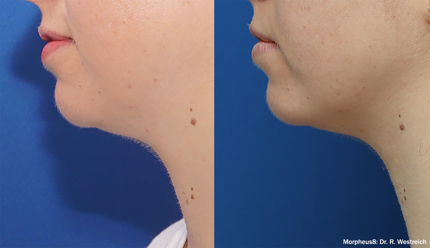 Morpheus8 Before and After Subdermal