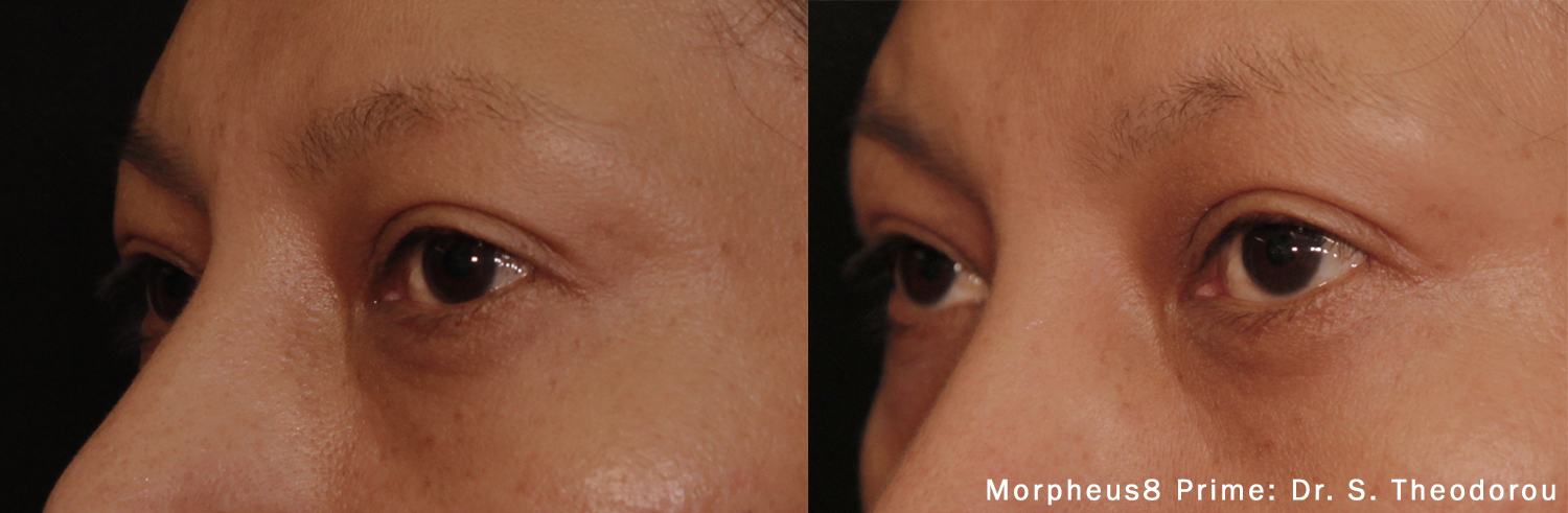 Morpheus8 Before and After Wrinkles