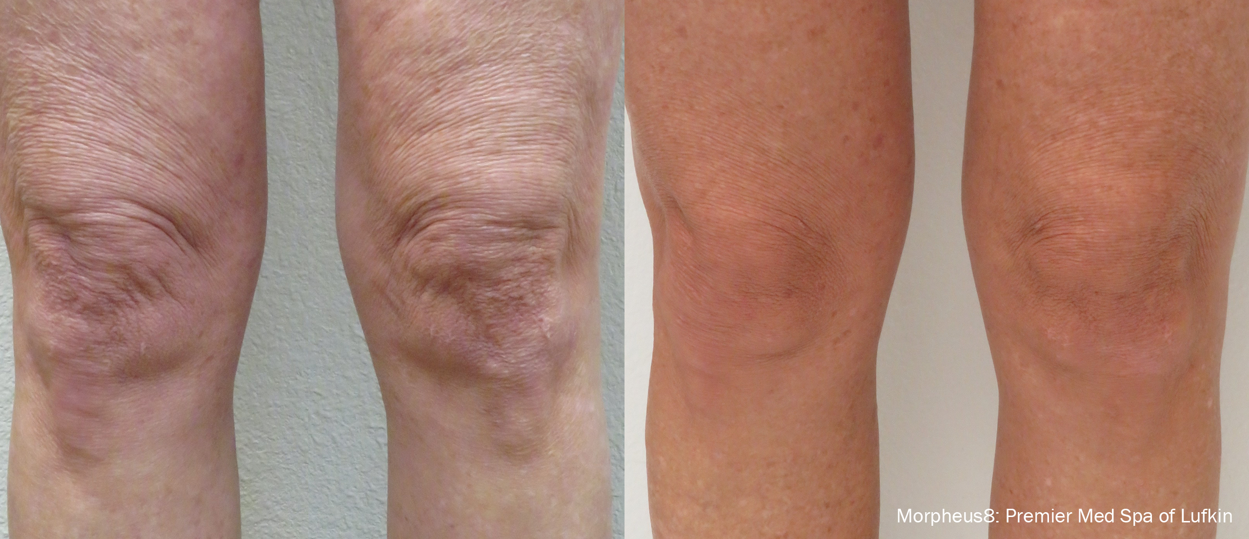 Morpheus8 Before and After Legs