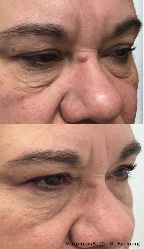 Before and After of Morpheus8 Wrinkle Removal